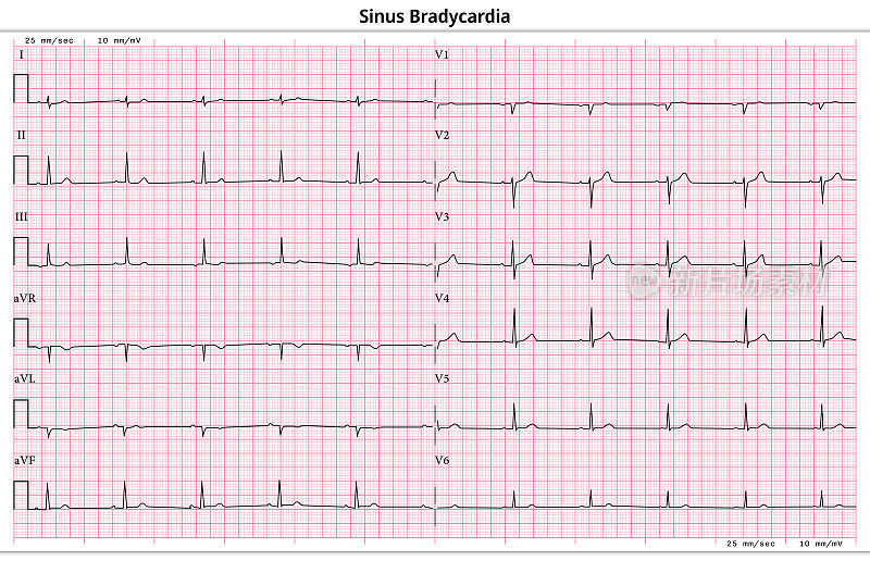 心电图窦性心动过缓- 12导联心电图常见病例- 6秒/导联